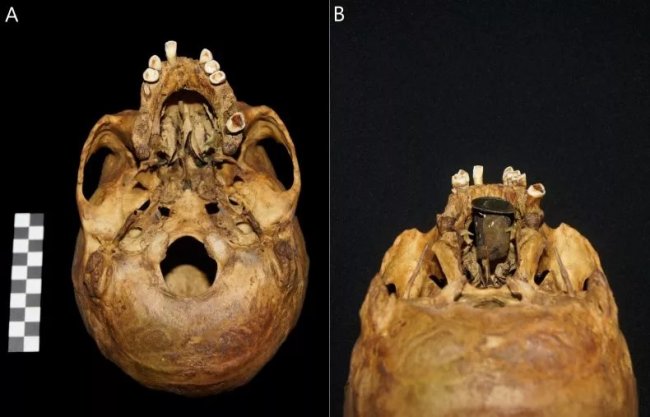 Археологи обнаружили искусственную часть тела в черепе XVIII века